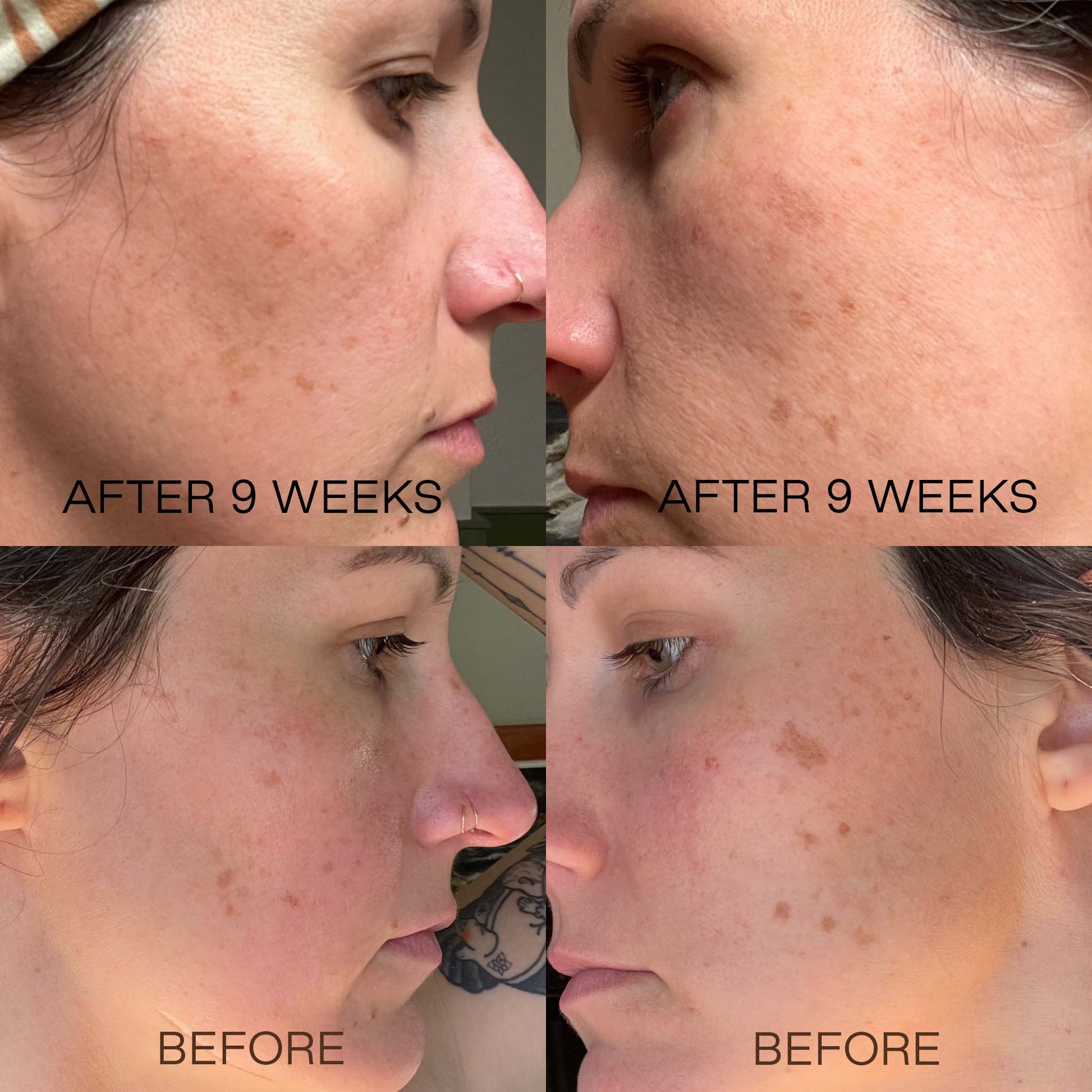 Before and after photos showing skin improvements after 9 weeks of using The Sunday Standard Brightening Vitamin C and E Booster Serum.